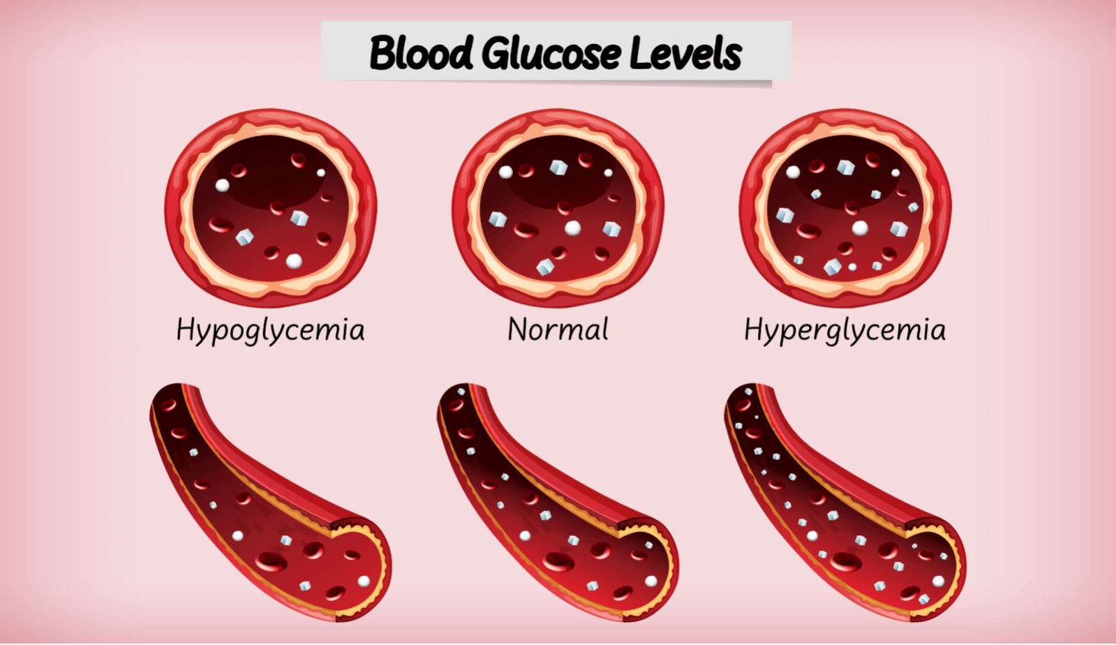 How to Recognize and Treat Hypoglycemia-Related Anxiety