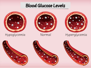 How to Recognize and Treat Hypoglycemia-Related Anxiety