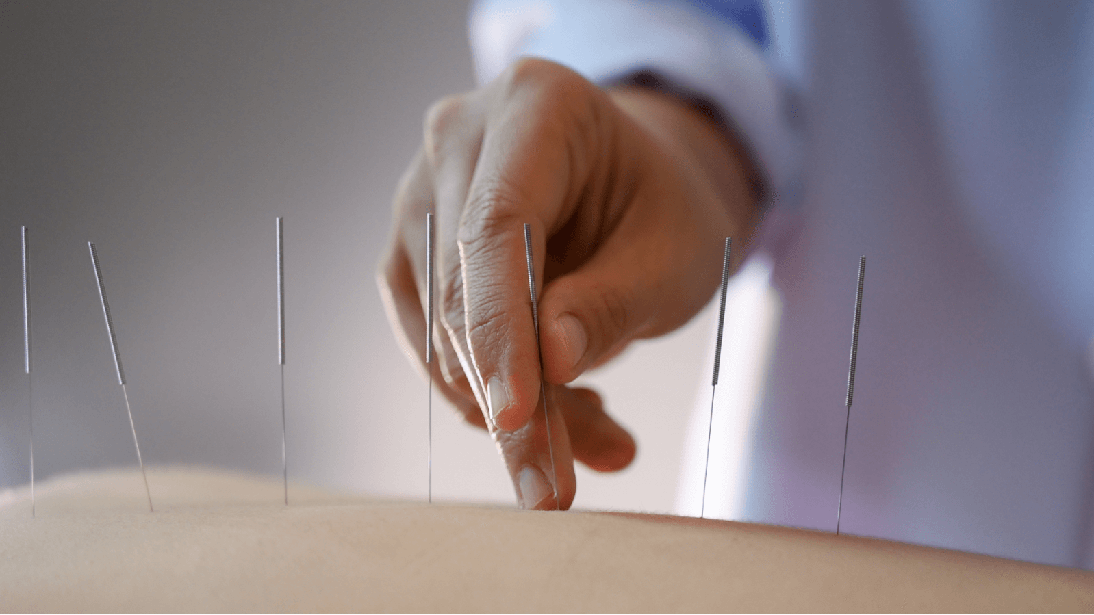 Does Acupuncture Help With Anxiety Problems?