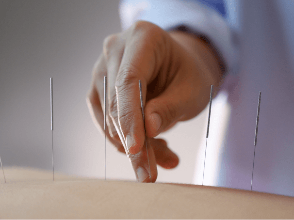 Does Acupuncture Help With Anxiety Problems?