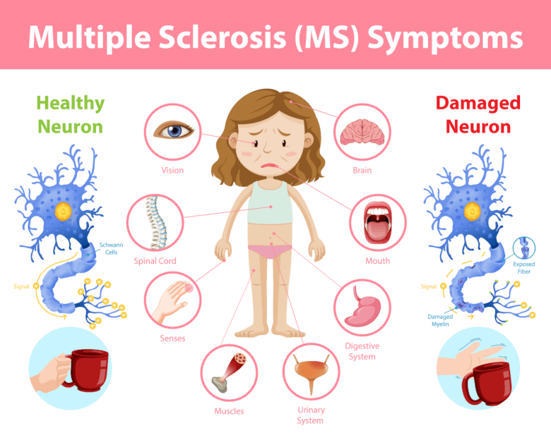 MS Attack (Relapse): Symptoms, Triggers, What To Do