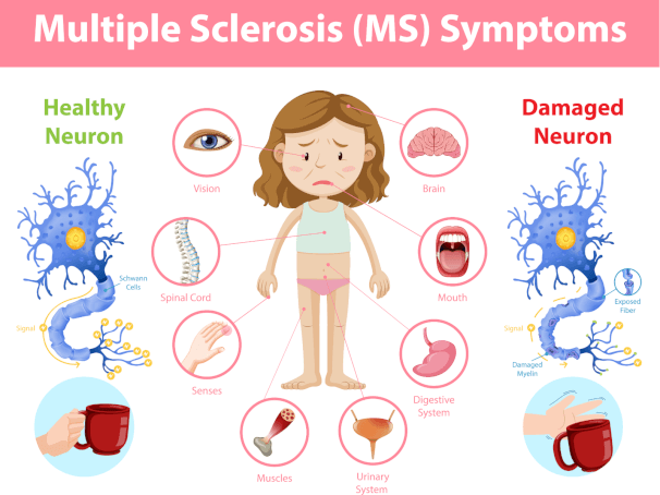 The Relationship Between Multiple Sclerosis and Anxiety